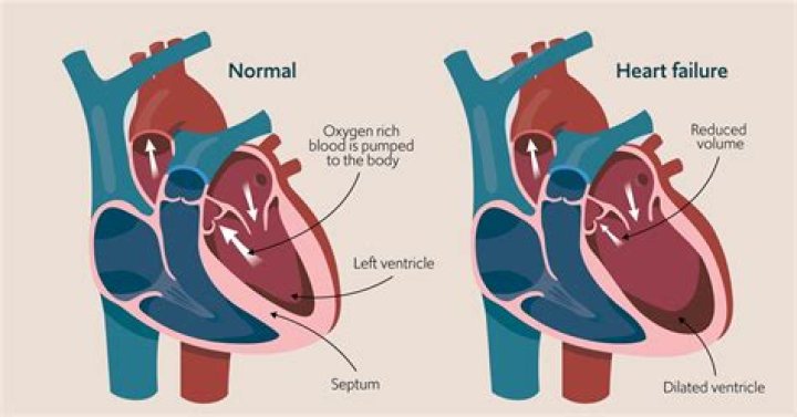 Can Enalapril cause heart failure