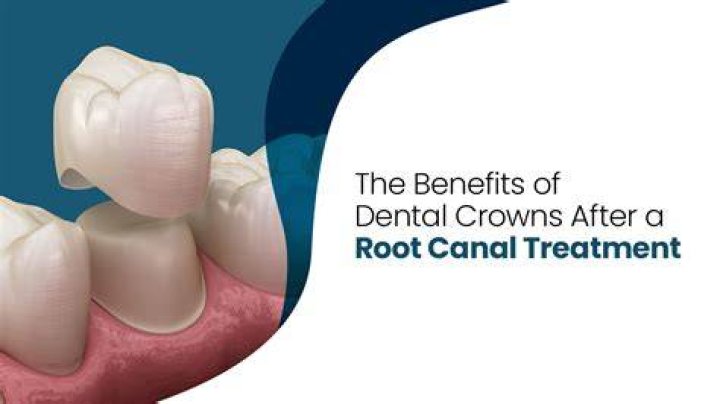 How soon after root canal should I get a crown