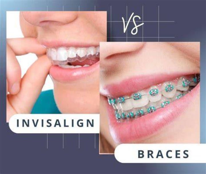 Is Invisalign Cheaper If I Already Had Braces