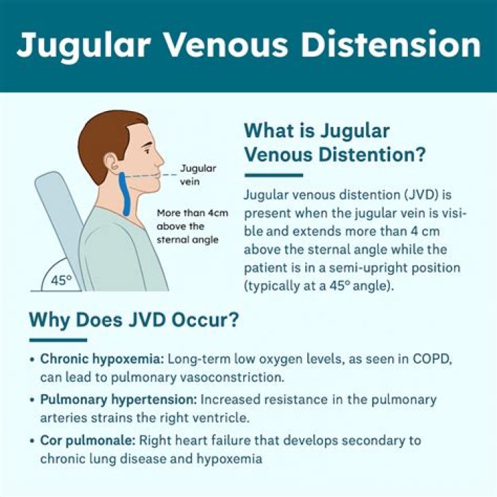 Is jugular vein distention dangerous