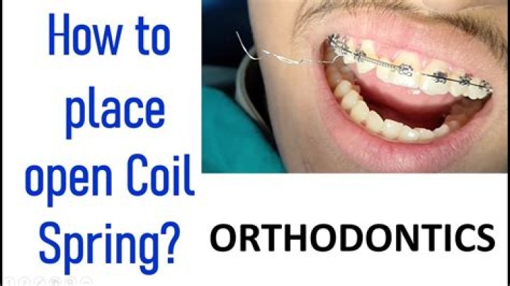 Open Coil Spring Braces - How To Discuss