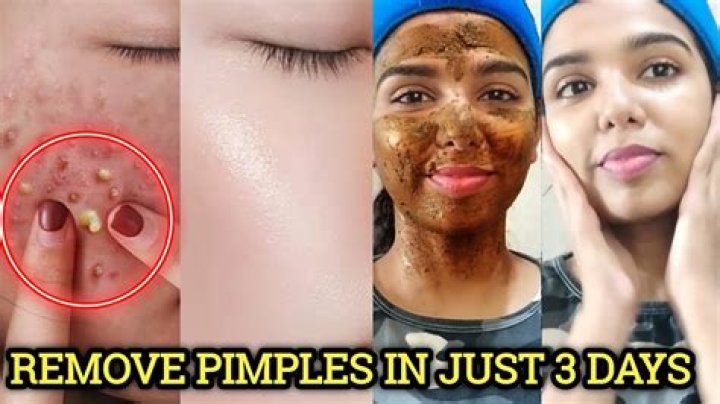 Pimple won t go away for months