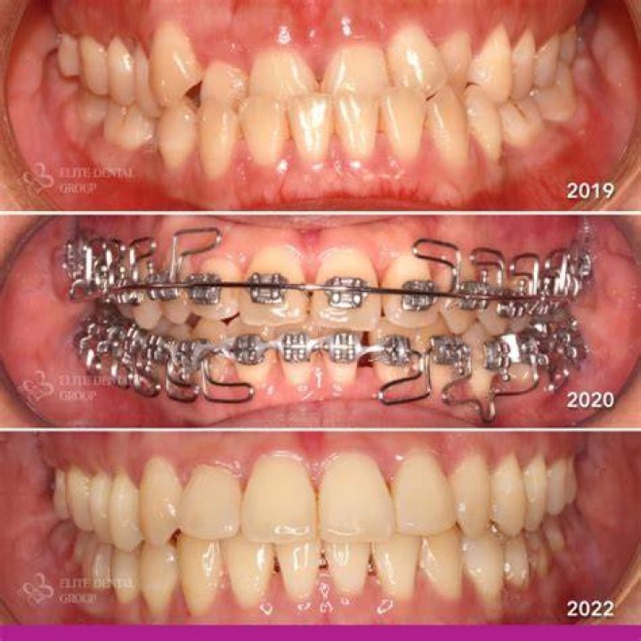 Retainer To Fix Underbite