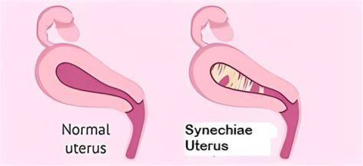 What causes uterine Synechiae