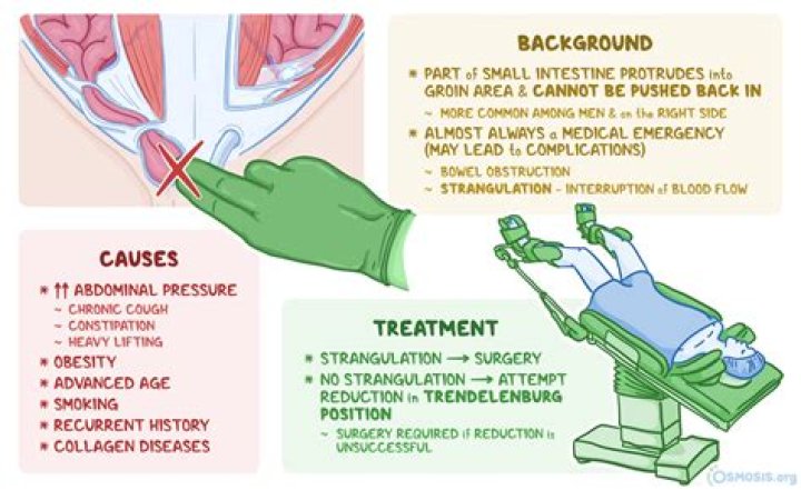 What is an incarcerated inguinal hernia